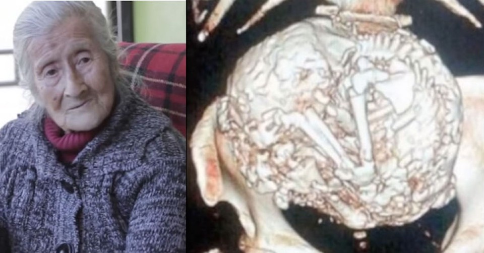 She was told by doctors that she had a massive tumor in her stomach. But further examination revealed a devastating truth.
