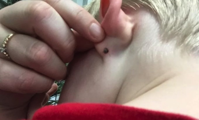 When they took him to the emergency room, doctors and parents were amazed at what they found behind his ear.