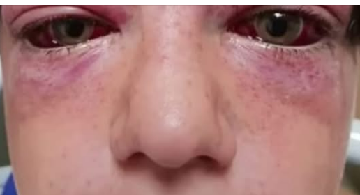 Playground craze leaves 11-year-old boy “looking like an alien”